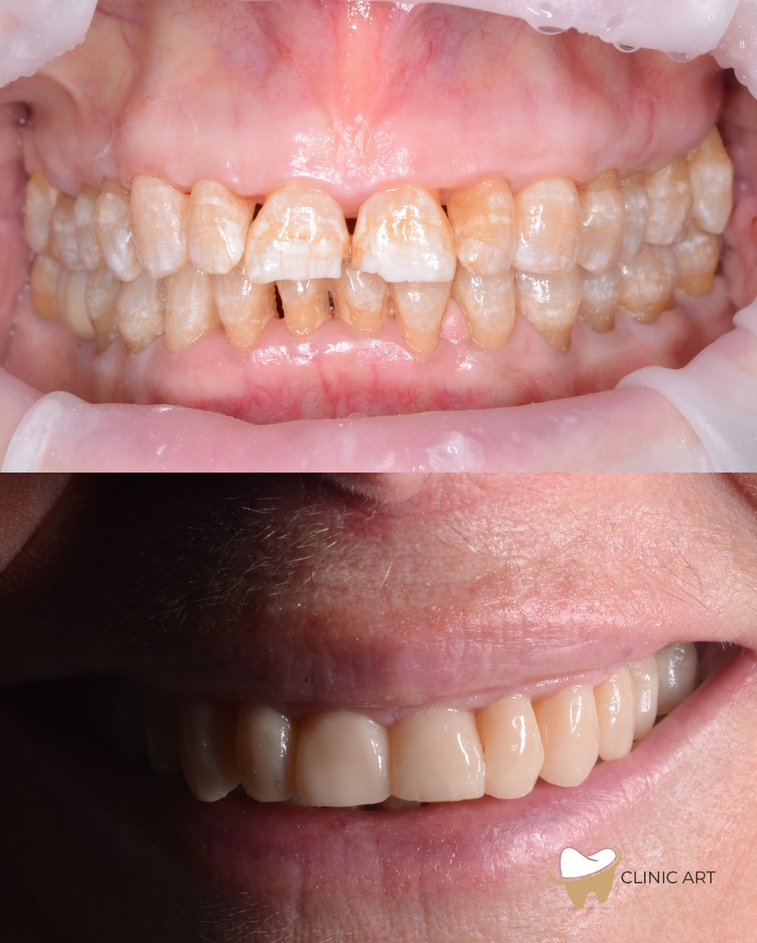 Resultado antes y después de carillas en paciente real de Clinic Art.