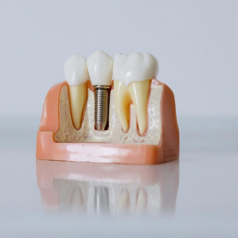 implantes dentales clinic art