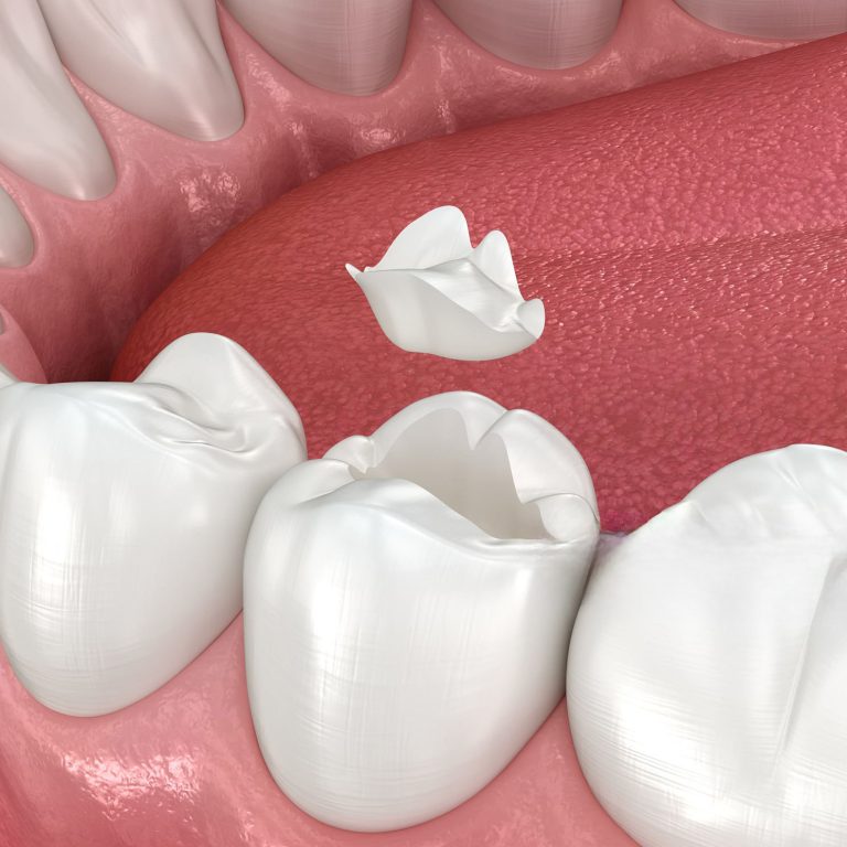 reconstruccion dental